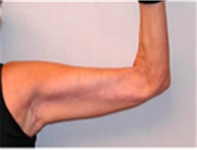 Arm Lift After Photo by Mariam Awada, MD, FACS; Southfield, MI - Case 40196