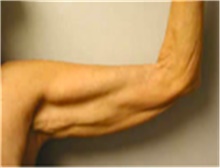 Arm Lift Before Photo by Mariam Awada, MD, FACS; Southfield, MI - Case 40196