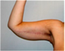 Arm Lift After Photo by Mariam Awada, MD, FACS; Southfield, MI - Case 40197