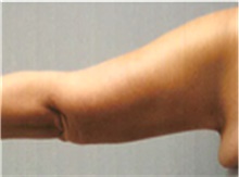 Arm Lift After Photo by Mariam Awada, MD, FACS; Southfield, MI - Case 40204