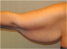 Arm Lift Before Photo by Mariam Awada, MD, FACS; Southfield, MI - Case 40204