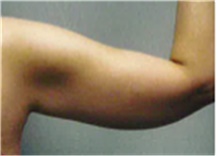 Arm Lift Before Photo by Mariam Awada, MD, FACS; Southfield, MI - Case 40211