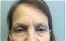 Brow Lift Before Photo by Mariam Awada, MD, FACS; Southfield, MI - Case 40218