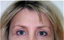 Brow Lift After Photo by Mariam Awada, MD, FACS; Southfield, MI - Case 40224