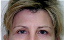 Brow Lift Before Photo by Mariam Awada, MD, FACS; Southfield, MI - Case 40224