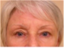 Brow Lift Before Photo by Mariam Awada, MD, FACS; Southfield, MI - Case 40225