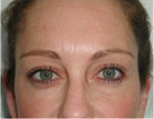 Brow Lift After Photo by Mariam Awada, MD, FACS; Southfield, MI - Case 40226