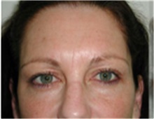 Brow Lift Before Photo by Mariam Awada, MD, FACS; Southfield, MI - Case 40226