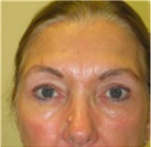 Brow Lift After Photo by Mariam Awada, MD, FACS; Southfield, MI - Case 40229