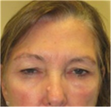 Brow Lift Before Photo by Mariam Awada, MD, FACS; Southfield, MI - Case 40229