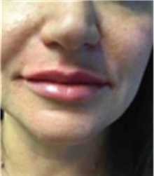 Dermal Fillers After Photo by Mariam Awada, MD, FACS; Southfield, MI - Case 40255