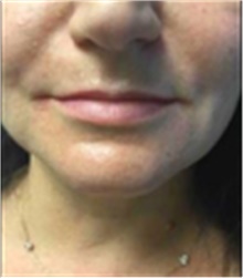 Dermal Fillers Before Photo by Mariam Awada, MD, FACS; Southfield, MI - Case 40255