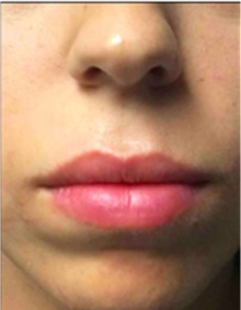 Dermal Fillers After Photo by Mariam Awada, MD, FACS; Southfield, MI - Case 40257