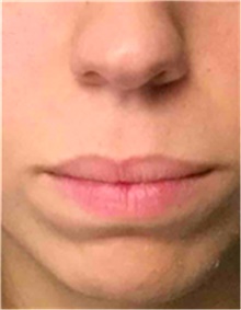 Dermal Fillers Before Photo by Mariam Awada, MD, FACS; Southfield, MI - Case 40257