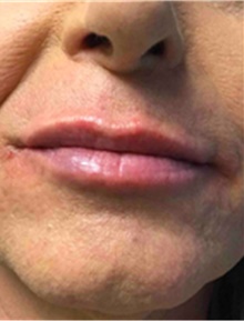 Dermal Fillers After Photo by Mariam Awada, MD, FACS; Southfield, MI - Case 40259