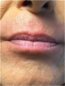 Dermal Fillers Before Photo by Mariam Awada, MD, FACS; Southfield, MI - Case 40259