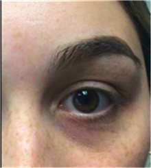 Dermal Fillers Before Photo by Mariam Awada, MD, FACS; Southfield, MI - Case 40266