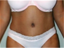 Tummy Tuck After Photo by Mariam Awada, MD, FACS; Southfield, MI - Case 40313