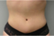 Tummy Tuck After Photo by Mariam Awada, MD, FACS; Southfield, MI - Case 40317