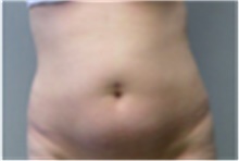 Tummy Tuck Before Photo by Mariam Awada, MD, FACS; Southfield, MI - Case 40317