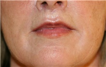 Lip Augmentation/Enhancement After Photo by Steve Laverson, MD, FACS; Rancho Santa Fe, CA - Case 40363