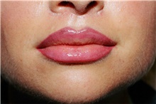 Lip Augmentation/Enhancement After Photo by Steve Laverson, MD, FACS; Rancho Santa Fe, CA - Case 40372