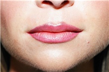 Lip Augmentation/Enhancement Before Photo by Steve Laverson, MD, FACS; Rancho Santa Fe, CA - Case 40372