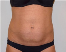 Liposuction Before Photo by David Rapaport, MD; New York, NY - Case 40442