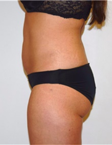 Liposuction After Photo by David Rapaport, MD; New York, NY - Case 40442