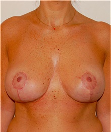 Breast Lift After Photo by David Rapaport, MD; New York, NY - Case 40463