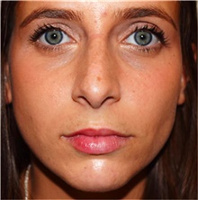 Rhinoplasty Before Photo by David Rapaport, MD; New York, NY - Case 40496