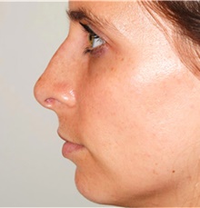 Rhinoplasty After Photo by David Rapaport, MD; New York, NY - Case 40496