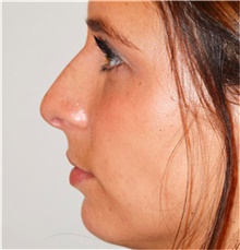 Rhinoplasty Before Photo by David Rapaport, MD; New York, NY - Case 40496