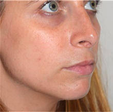 Rhinoplasty After Photo by David Rapaport, MD; New York, NY - Case 40496