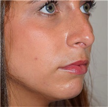 Rhinoplasty Before Photo by David Rapaport, MD; New York, NY - Case 40496