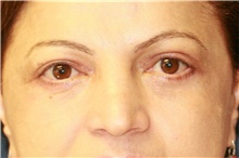 Eyelid Surgery After Photo by Steve Laverson, MD, FACS; Rancho Santa Fe, CA - Case 40747