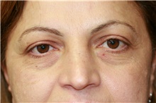 Eyelid Surgery Before Photo by Steve Laverson, MD, FACS; Rancho Santa Fe, CA - Case 40747