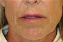 Lip Augmentation/Enhancement Before Photo by Steve Laverson, MD, FACS; Rancho Santa Fe, CA - Case 40791