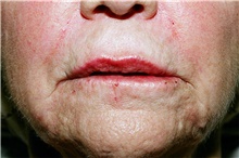 Lip Augmentation/Enhancement Before Photo by Steve Laverson, MD, FACS; Rancho Santa Fe, CA - Case 40922