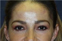 Brow Lift After Photo by Steve Laverson, MD, FACS; Rancho Santa Fe, CA - Case 40960