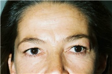 Brow Lift Before Photo by Steve Laverson, MD, FACS; Rancho Santa Fe, CA - Case 40960