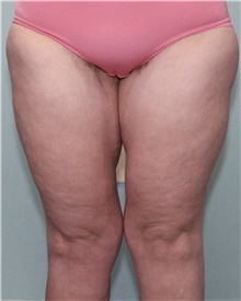 Thigh Lift After Photo by Jennifer Greer, MD; Mentor, OH - Case 41044