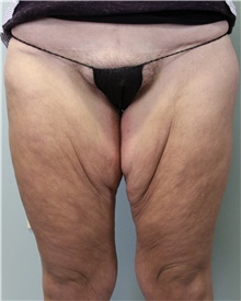 Thigh Lift Before Photo by Jennifer Greer, MD; Mentor, OH - Case 41044