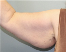 Arm Lift Before Photo by Jennifer Greer, MD; Mentor, OH - Case 41104