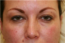 Eyelid Surgery Before Photo by Steve Laverson, MD, FACS; Rancho Santa Fe, CA - Case 41123