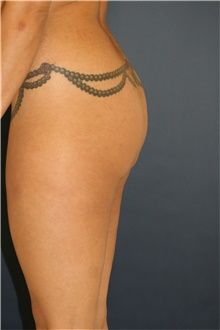 Buttock Lift with Augmentation Before Photo by Steve Laverson, MD, FACS; Rancho Santa Fe, CA - Case 41350