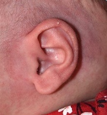 Ear Surgery After Photo by Rachel Ruotolo, MD; Garden City, NY - Case 41357