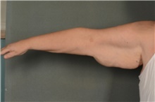 Arm Lift Before Photo by Ellen Janetzke, MD; Bloomfield Hills, MI - Case 41366