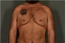 Male Breast Reduction Before Photo by Ellen Janetzke, MD; Bloomfield Hills, MI - Case 41371