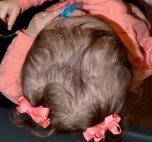 Craniosynostosis After Photo by Rachel Ruotolo, MD; Garden City, NY - Case 41372